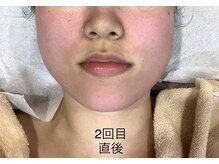 エステティック レイビス 池袋店(RAYVIS)/ハーブピーリング直後