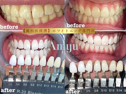 アミュホワイトニングの写真