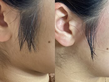 ディスイズミー シュガーリング(This is me Sugaring)の写真/【心斎橋/難波5分】メイクノリ&トーンUPに◎天然素材使用《全顔シュガーリング+保湿鎮静パック付き》