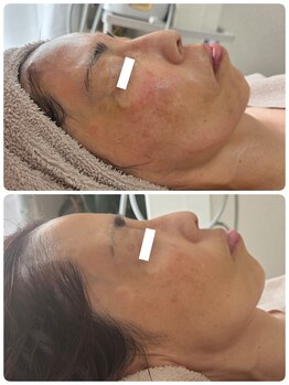 サロン ジョリ(Salon Jolie)/セラピールでエイジングケア♪