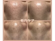 ピュリフィケーション(Purification)の雰囲気（毛穴の黒ずみは、1回の施術でも♪）