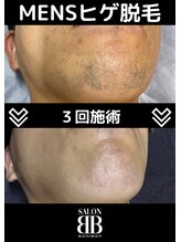 ビービー(BB)/メンズひげ脱毛