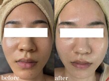 ホワイトアクア 北千住店(WHITE AQUA)/ハーブピーリング7回/くすみ改善