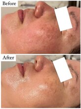 サロン アンス(anse)/ハーブピーリング