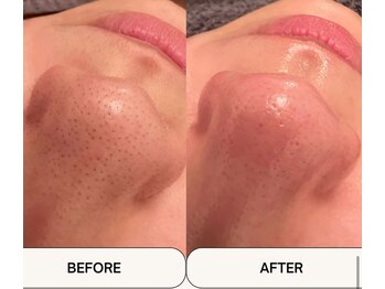 シンデレラ しみケア(Cinderella)/毛穴洗浄＋Wax＋毛穴縮小マシン