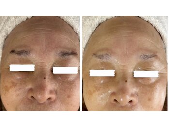 マリエンドリー/速攻美白