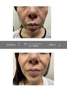 青空 天神大名店(SORA)/マイクロチップ顔 &nbsp;1回