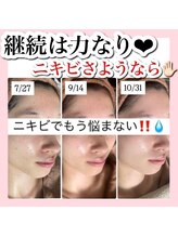 アルムダアクア 天王寺店(Aleumda AQUA)/ハーブピーリング/大阪/天王寺