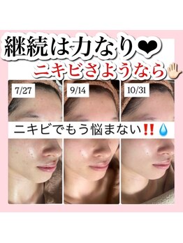 アルムダアクア 天王寺店(Aleumda AQUA)/ハーブピーリング/大阪/天王寺