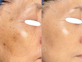 ポ ワール(Poir)/しみケア