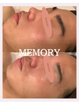 メモリー(MEMORY)/毛穴の素晴らしい変化☆