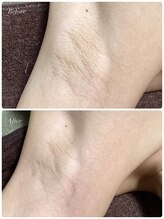 シャナ(Shana)/カーボキシーボディ(脇)