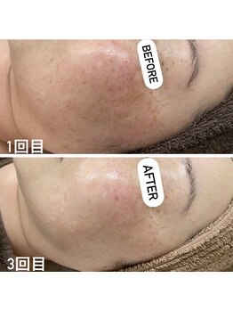 カルディエ(Cardie)/肌質改善　ビフォーアフター