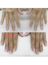 アイネイルズ 布施店(I.NAILS)/深爪/深爪矯正/自爪風ネイル