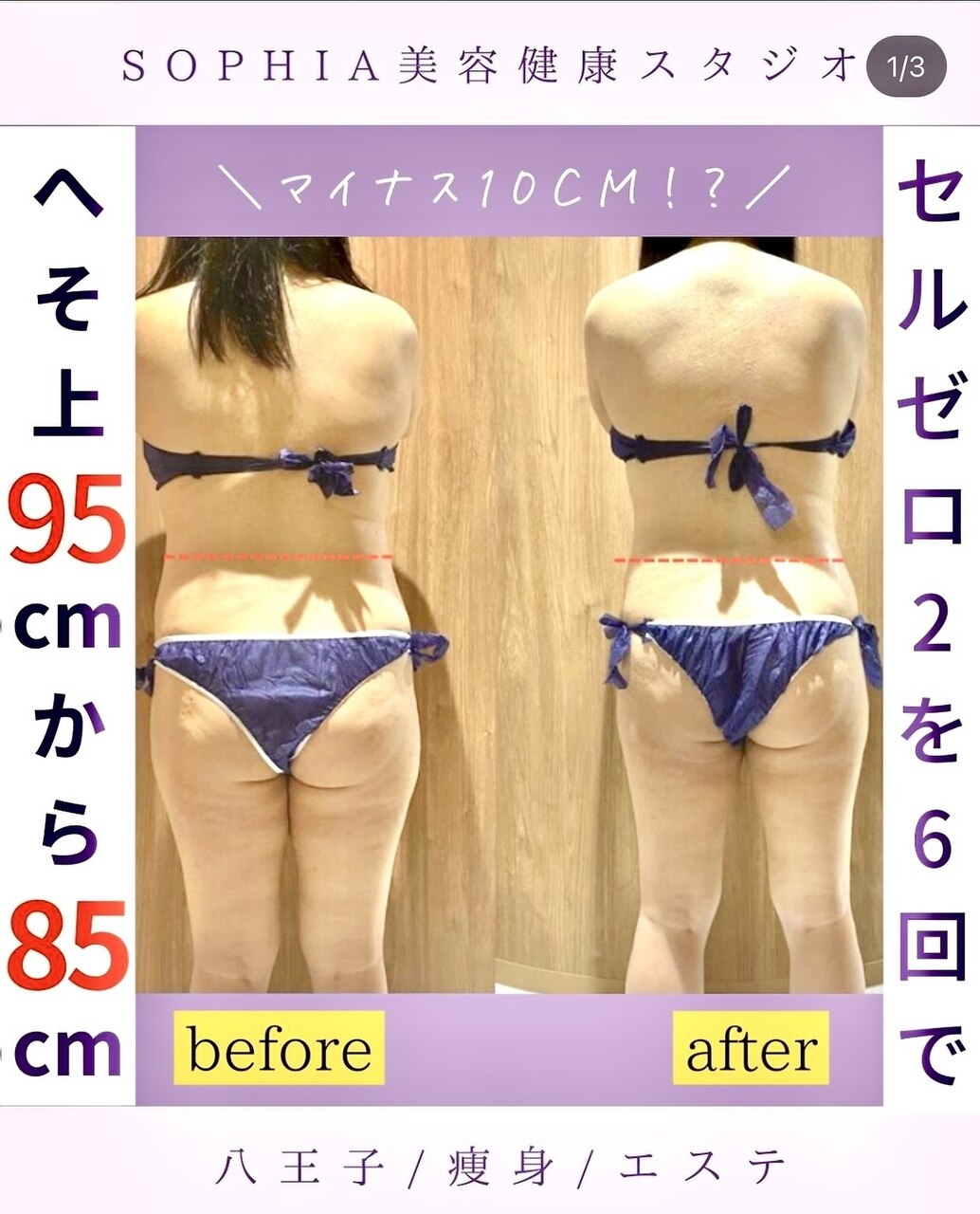 セルライト除去 セルスイーパー