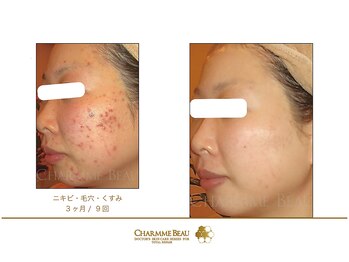 アムレット(Amourette)/ニキビ悩みもここまで改善★