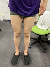 フレッシュ脱毛ドットコム(Flesh脱毛.com)/脚まるごと脱毛 施術2週間後