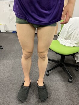 フレッシュ脱毛ドットコム(Flesh脱毛.com)/脚まるごと脱毛 施術2週間後