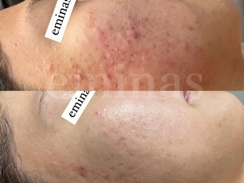 エミナス(EMINAS)/ニキビ改善