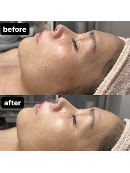 ブルーム(bloom)/ハーブピーリング/ララピール