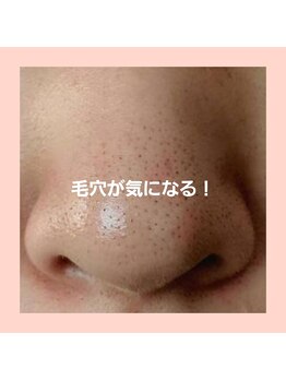 キヨラ(kiyora)の写真/毛穴が変われば、肌印象が変わる。肌質改善のプロが提案する毛穴徹底攻略メニュー☆