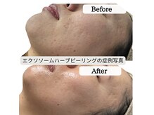 ル ボヌール 伊那店(le bonheur)の雰囲気（毛穴、肌荒れ跡、細胞ケア！エクソソームハーブピーリング♪）