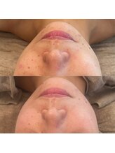 ベルチャーム(Bellecharm)/食生活の乱れ・大人ニキビケア