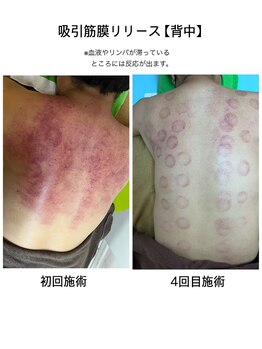 介正鍼灸整骨院つきぐま/吸引筋膜リリース