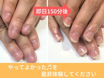 アリエ(allie)/即日見た目を変えられる深爪矯正