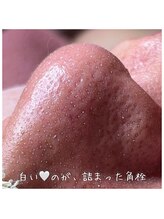 リエラ(Liella)/目に見える毛穴詰まり