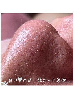 リエラ(Liella)/目に見える毛穴詰まり
