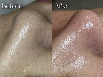 ヨハク 市川店(yohaku)/毛穴洗浄