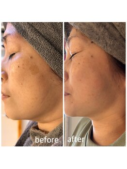 マイルーチェ 可児川合店(MyLuce)/シミ/たるみ/改善