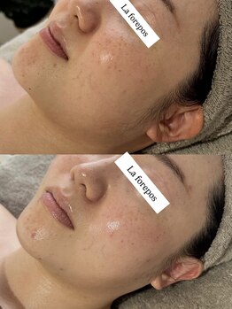 ラ フォルポ 恵比寿(La forepos)/verunaハーブピーリング恵比寿