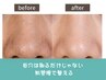 【人気No.1】黒ずみ・角栓ごっそり★全顔毛穴洗浄+吸引ケア ¥4,900