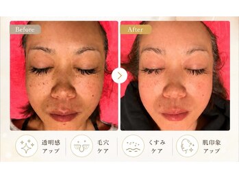 テテアテテ(tete a tete)の写真/夏の紫外線を浴びた肌に◎シミ・くすみ・たるみ毛穴を光でケア♪つるんとハリ・ツヤのある明るい印象肌へ