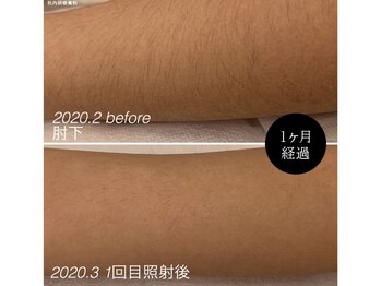 リネ(Rine)/【before→after】