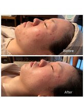 ルーチェ(Luce)/マイクロニードルピーリング