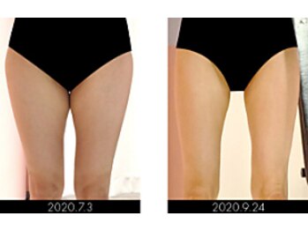 ラグラン銀座メディカルエステ 高輪ゲートウェイ店/【BODY】セルマジ・ビフォアフ