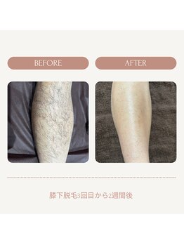 シュエット(Chouette)/膝下 before after