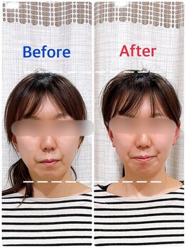 イズム まつもと店(izm)/小顔モニター様