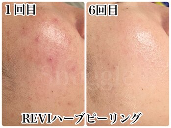 スナグル(Snuggle)/REVIハーブピーリング