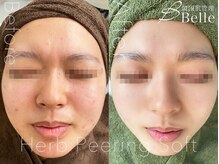 ベル 赤羽(Belle)/ハーブピーリング｜ニキビケア