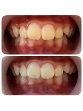 ブラン(BLANC.)/セルフホワイトニング