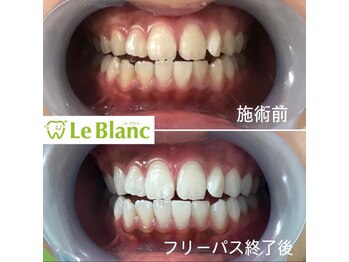 ルブラン 奈良店(Le Blanc)/ホワイトニングはお済みですか?