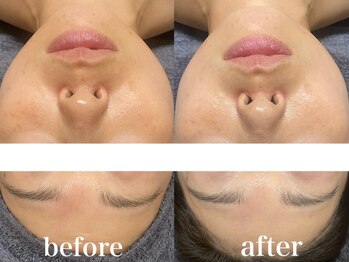 ビジュープラス 松本店(Bijou+)/ハーブピーリング