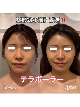 ティアラ(TIARA)/【小顔、たるみ】テラボーラー