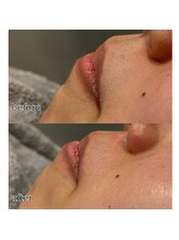 アデル 久留米(ADEL)/フェイシャルワックス《口周り》