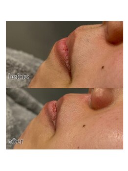 アデル 久留米(ADEL)/フェイシャルワックス《口周り》