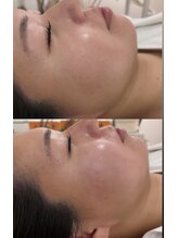 マホロバ(mahoroba)/ダーマ鍼で肌質改善